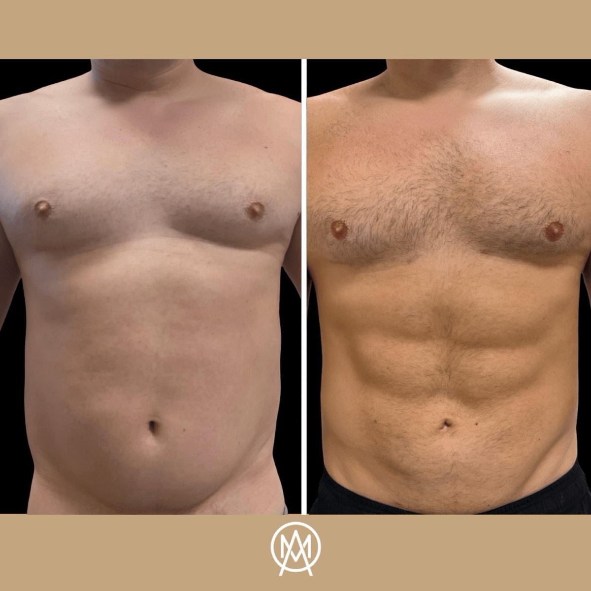 Male torso before and after abdominal etching — defined abdominal muscles on the after frame