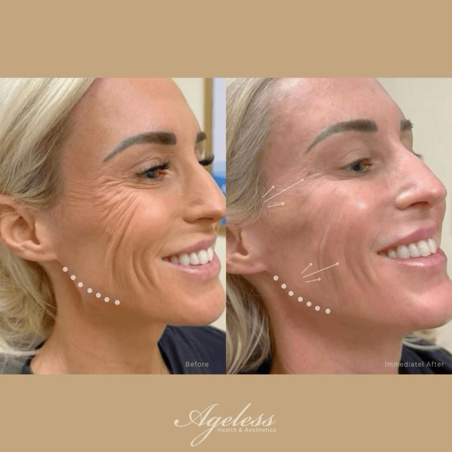 Three-quarter view before and after dermal filler - softened contours on the after frame