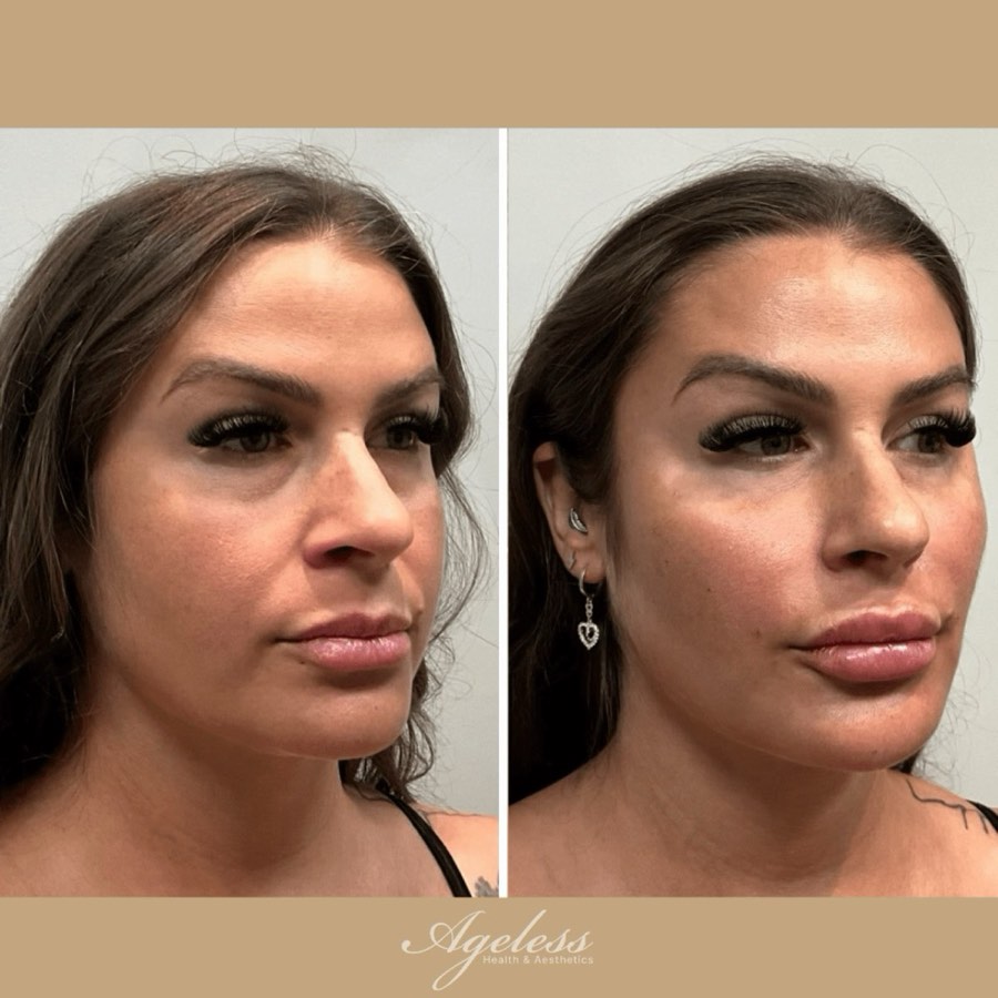 Three-quarter view before and after lip filler - fuller lips and enhanced profile after