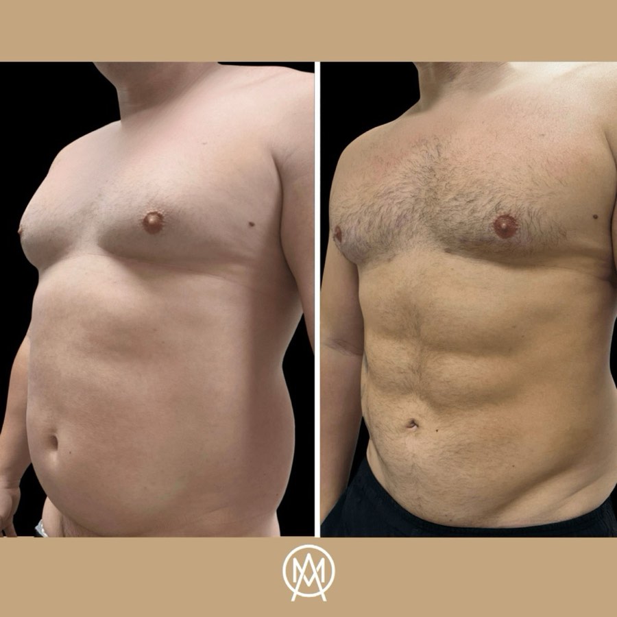 Male torso at an oblique angle before and after abdominal etching - defined contours on the after frame