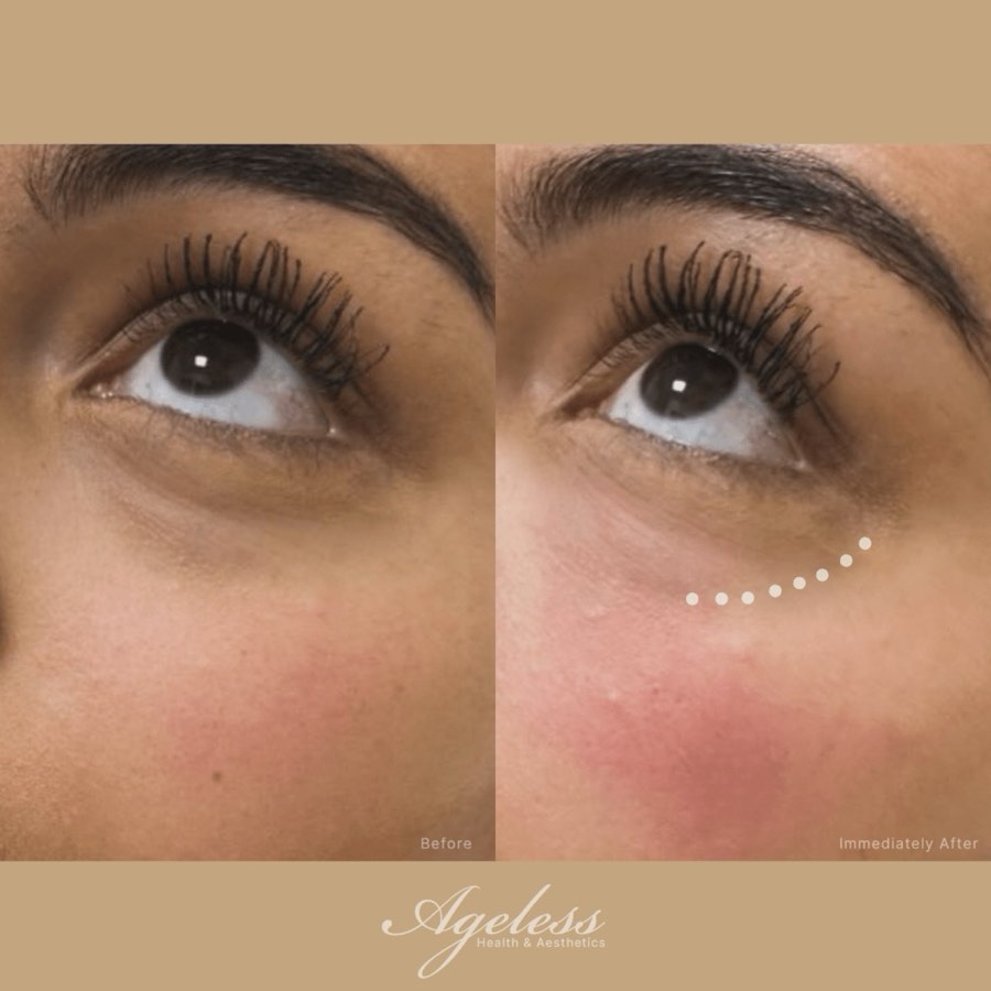Under-eye area before and immediately after PRFM treatment — reduced hollowing after