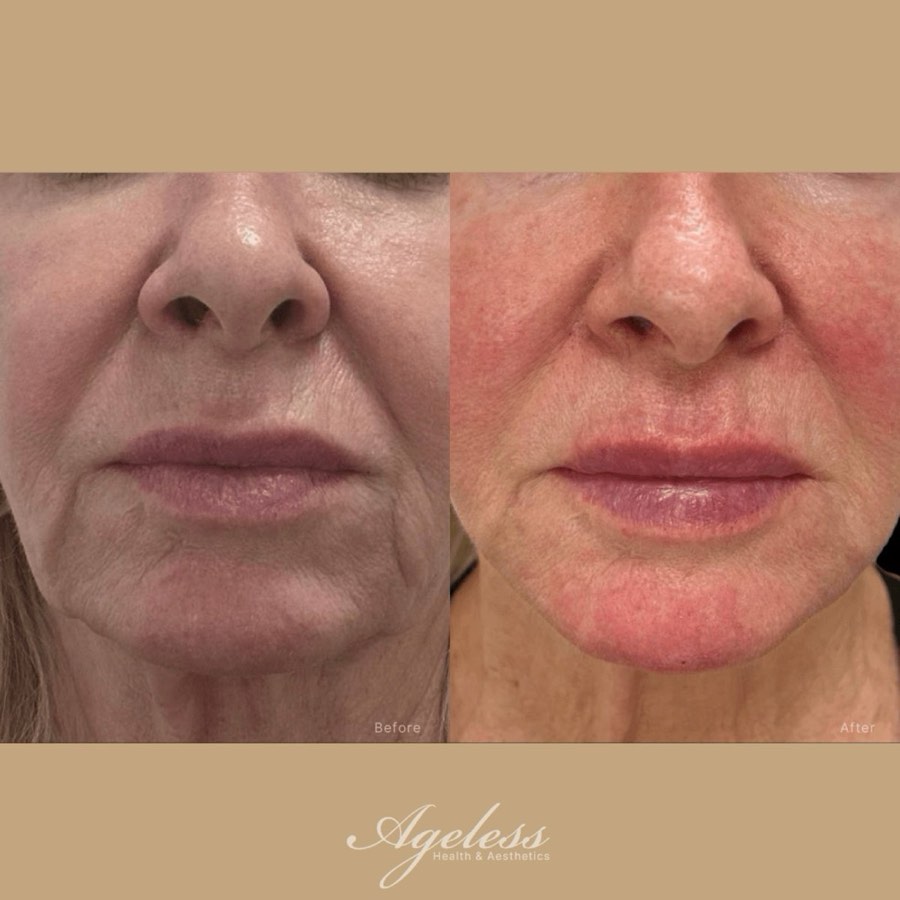 Lower face before and after a thread lift, front view - before on the left, after on the right
