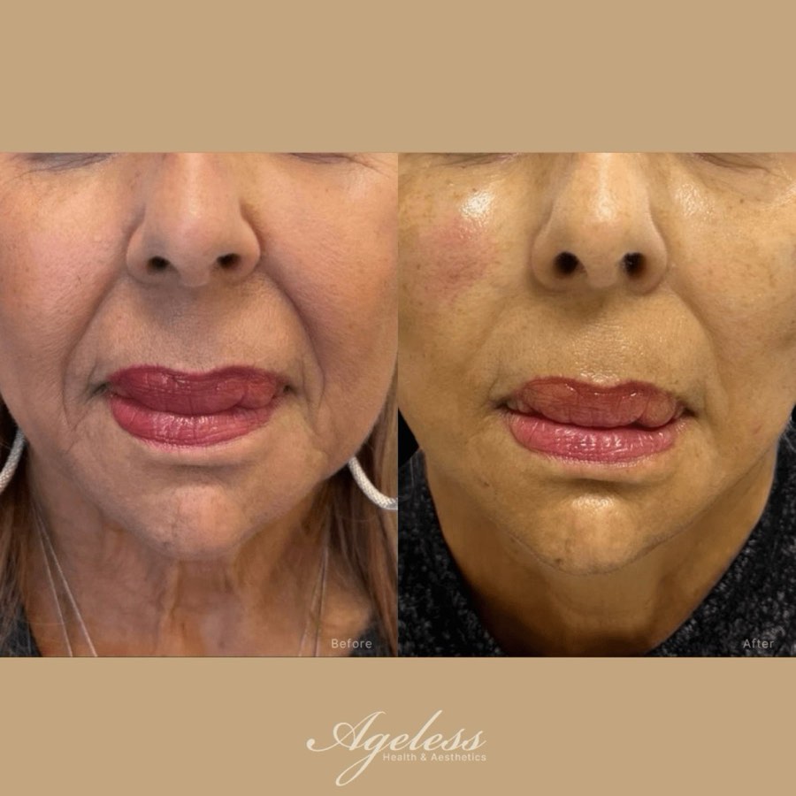 Mouth, chin and neck before and after a lower-face thread lift - before on the left, after on the right