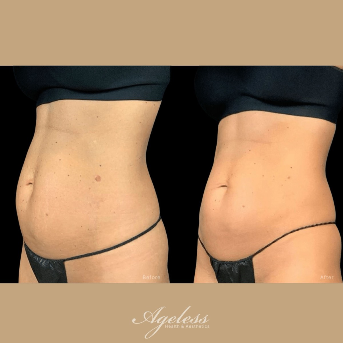 Abdomen before and after Emsculpt — flatter, more toned midsection on the after frame