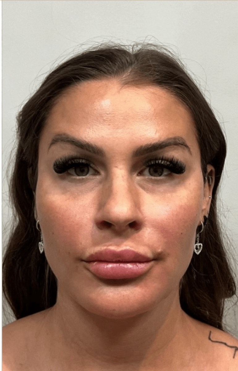 The same patient after fat transfer with AlloClae to the nasolabial folds, cheeks and jawline, front view