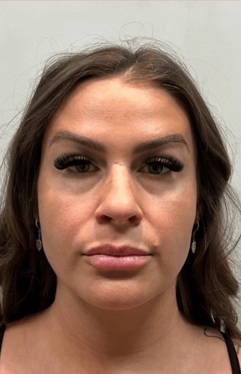 Patient before fat transfer with AlloClae to the nasolabial folds, cheeks and jawline, front view