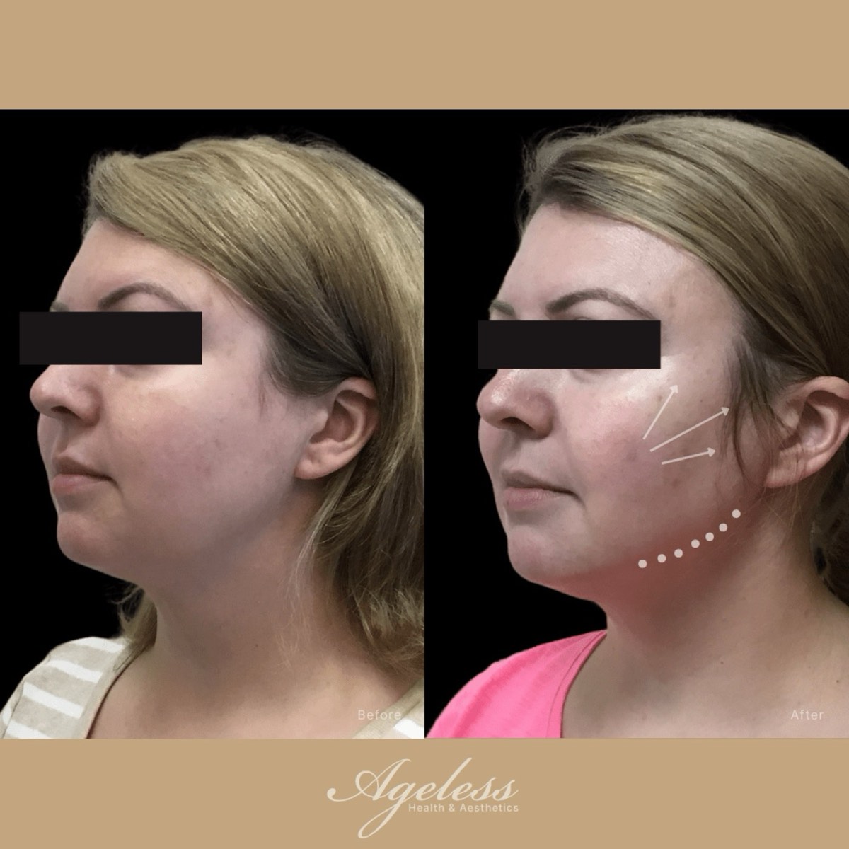 Before and after of a PDO thread lift in three-quarter profile, with lift-direction markings on the after frame
