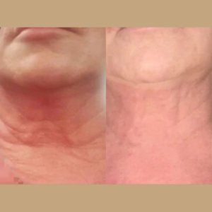 pure-plasma-neck-tightening